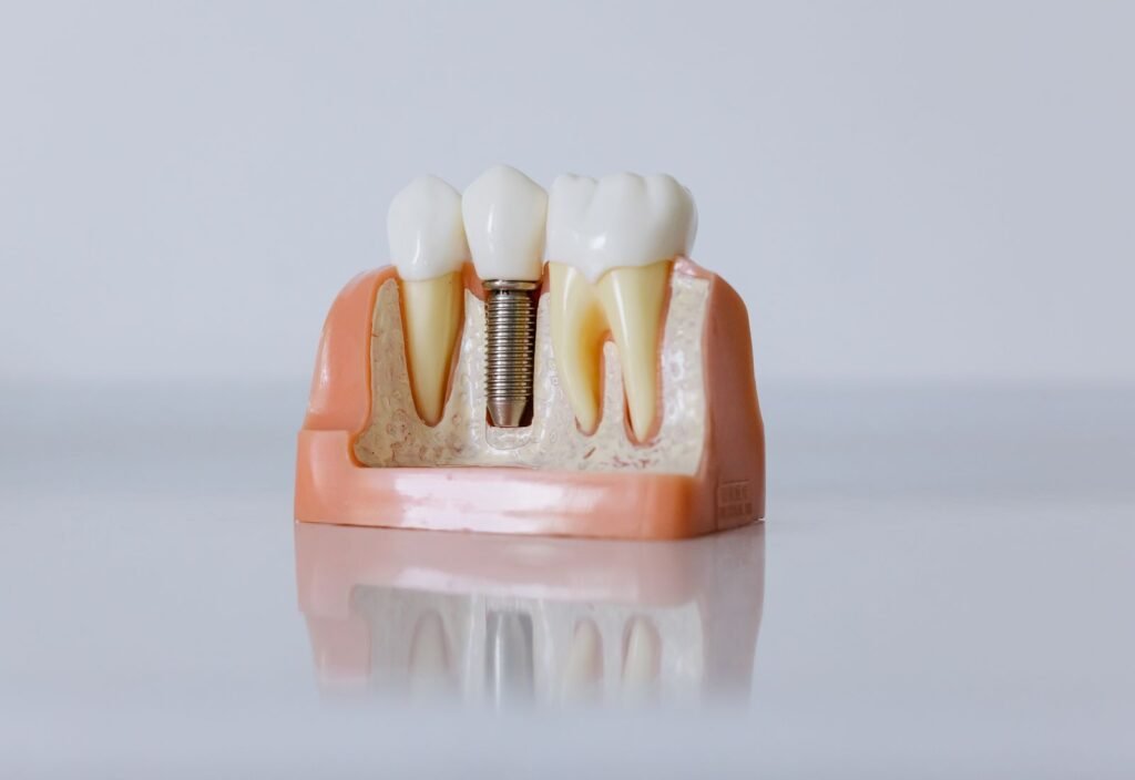 Implantes dentales: proceso, duración y cuidados reales