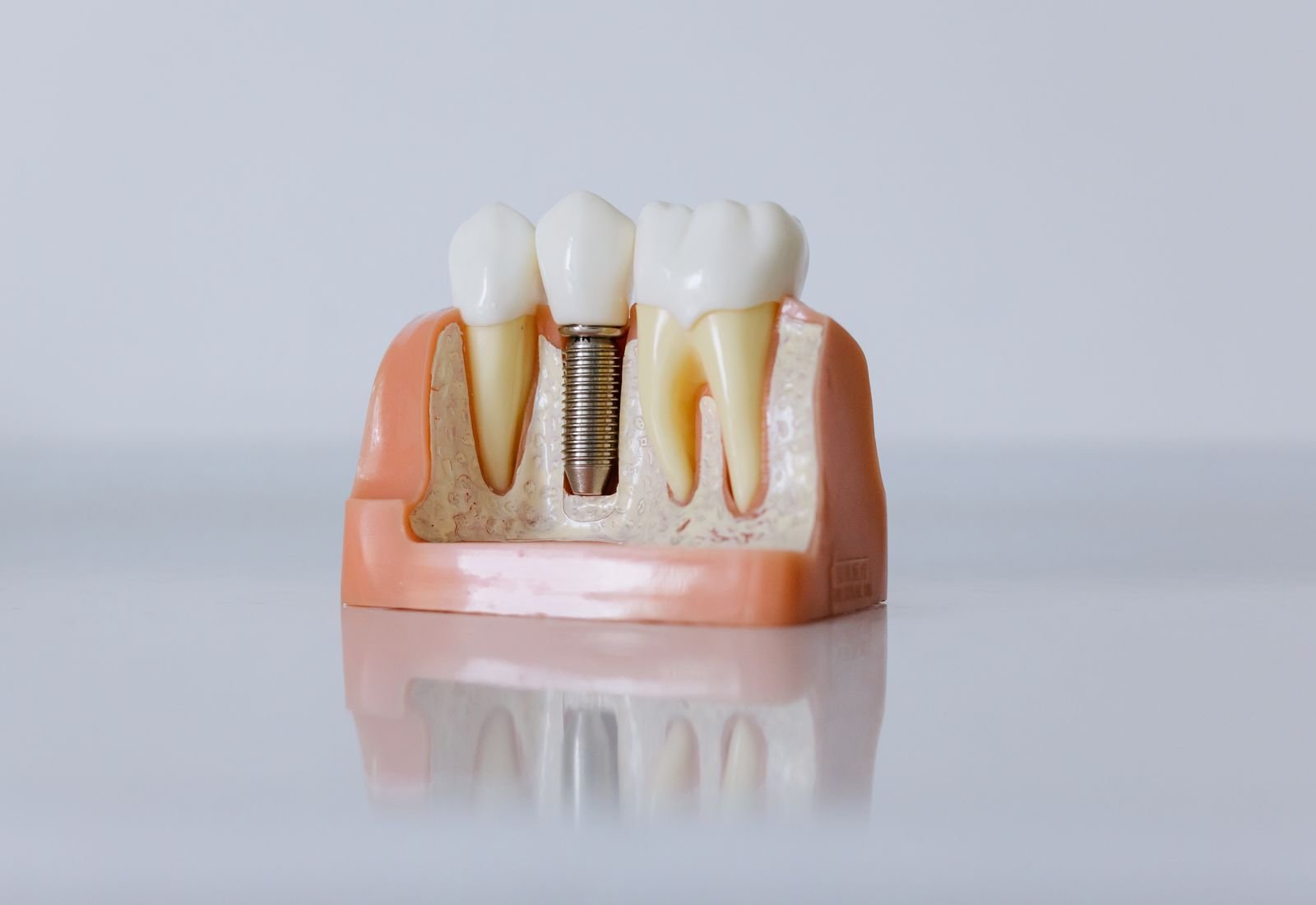 Implantes dentales: proceso, duración y cuidados reales