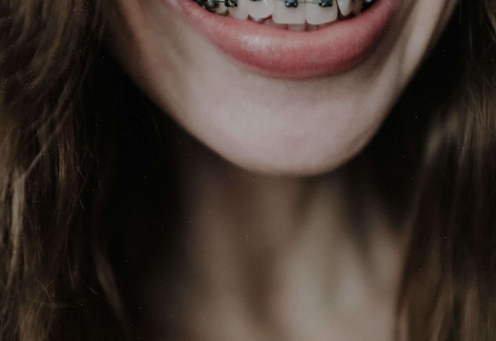 Ortodoncia para adultos y adolescentes: brackets o alineadores
